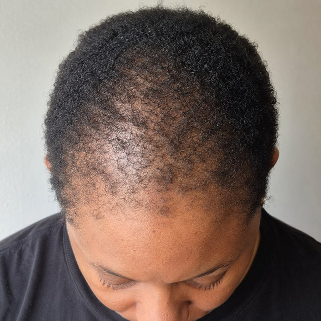 Illustrative simulation: thinning edges and crown on coily hair before use